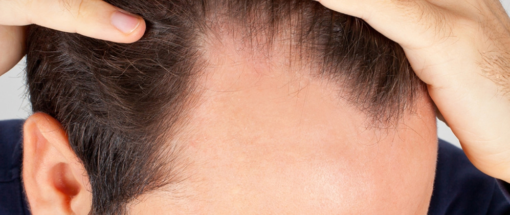 Things to be Considered Before Hair Transplantation?