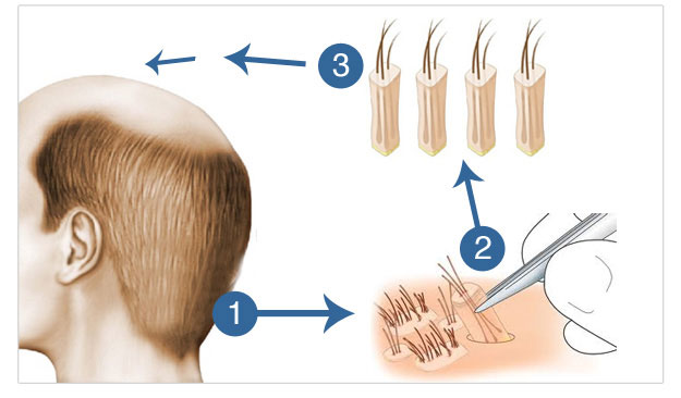 Hair Transplantation With Fue Technique